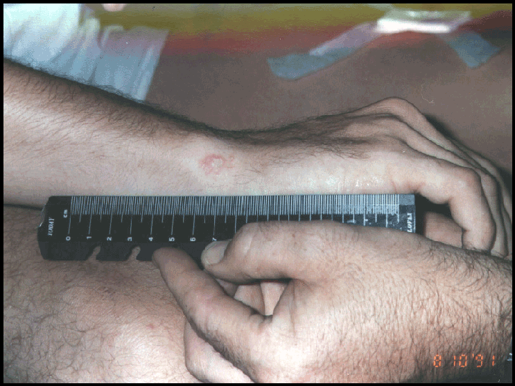 Figure 15. Photograph of injured British soldier taken by the sampling team leader, August 10, 1991